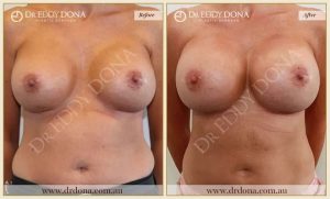 Breast Augmentation 27 - 26