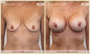 Breast Augmentation 40 - 39