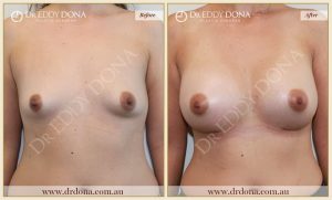 Breast Augmentation 46 - 45