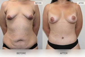 Post-Pregnancy Surgery Patient 10 - 11