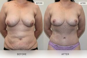 Post-Pregnancy Surgery Patient 12 - 13