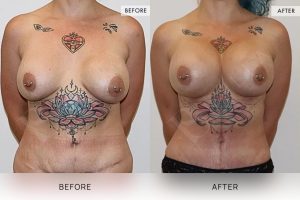 Post-Pregnancy Surgery Patient 15 - 16