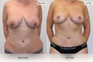 Post-Pregnancy Surgery Patient 17 - 18