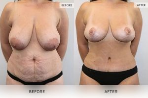 Post-Pregnancy Surgery Patient 18 - 19