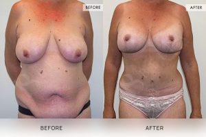 Post-Pregnancy Surgery Patient 20 - 21