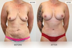 Post-Pregnancy Surgery Patient 04 - 5