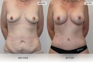 Post-Pregnancy Surgery Patient 07 - 8