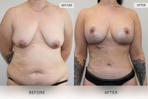 Post-Pregnancy Surgery Patient 09 - 10