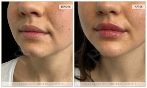 Chin Augmentation Patient 10 - 11