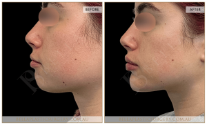 Chin Augmentation Patient 05 - 6