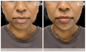 Chin Augmentation Patient 06 - 7