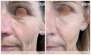 Cheek Enhancement Patient 01 - 2