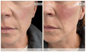 Cheek Enhancement Patient 02 - 3