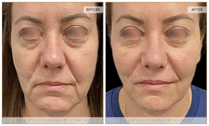 Cheek Enhancement Patient 03 - 4