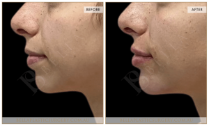 Chin Augmentation Patient 03 - 4