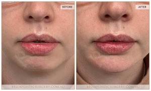 Chin Augmentation Patient 04 - 5