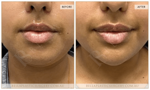 Chin Augmentation Patient 07 - 8