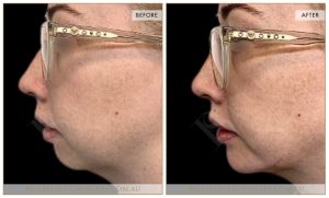 Chin Augmentation Patient 09 - 10