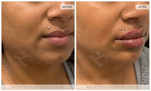 Chin Augmentation Patient 11 - 12