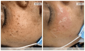 Age Spots Patient 02 - 3