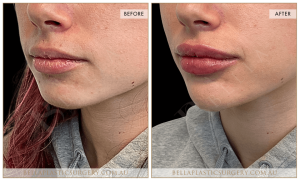 Chin Augmentation Patient 02 - 3