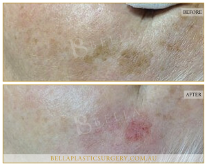 Age Spots Patient 03 - 4
