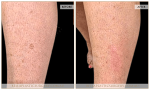 Age Spots Patient 04 - 5