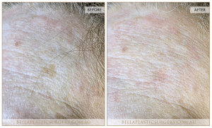 Age Spots Patient 05 - 6