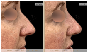 Non-Surgical Rhinoplasty 11 - 12