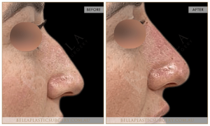 Non-Surgical Rhinoplasty 12 - 13