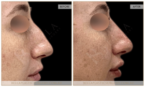 Non-Surgical Rhinoplasty 15 - 16