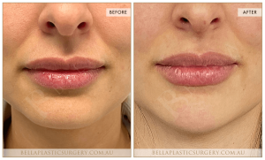 Chin Augmentation Patient 08 - 9