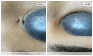 Laser Mole Removal 02 - 3
