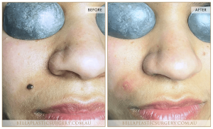 Laser Mole Removal 03 - 4