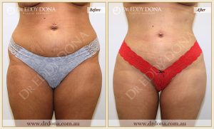 Buttock Lift Patient 02 - 2