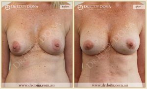 Revision Breast Patient 22 - 23
