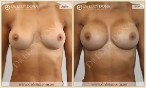 Revision Breast Patient 14 - 15