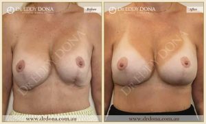 Revision Breast Patient 19 - 20