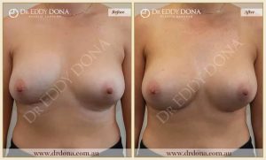 Revision Breast Patient 20 - 21