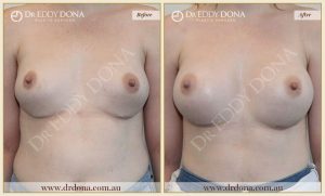 Revision Breast Patient 13 - 14