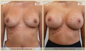 Revision Breast Patient 17 - 18