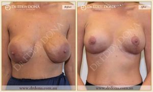 Revision Breast Patient 7 - 8