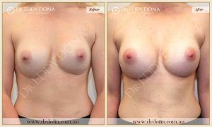 Revision Breast Patient 8 - 9