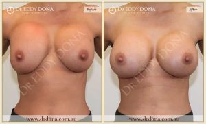 Revision Breast Patient 5 - 6