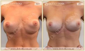 Revision Breast Patient 2 - 3