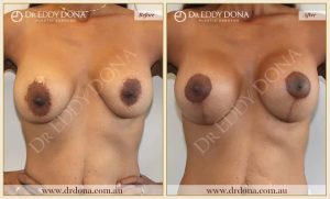 Revision Breast Patient 4 - 5