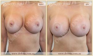 Revision Breast Patient 11 - 12