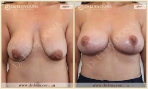 Revision Breast Patient 12 - 13