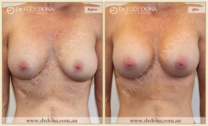 Revision Breast Patient 10 - 11