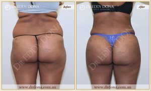 Buttock Lift Patient 01 - 1